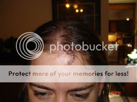 Head Stitches Pictures Images And Photos Photobucket