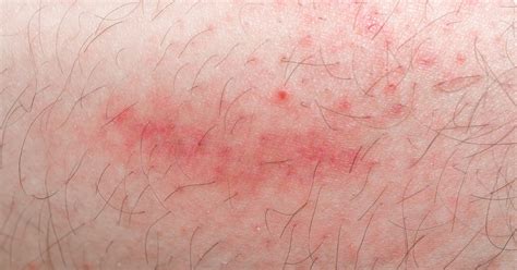 Allergic Reactions And Skin Rash Aesthetic Dermatolog