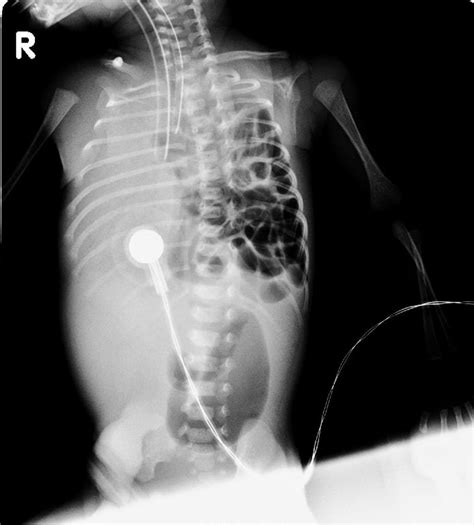 Diaphragmatic Hernia Chest X Ray Wikidoc