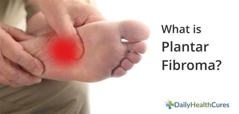 What Is Plantar Fibroma And How Is It Treated