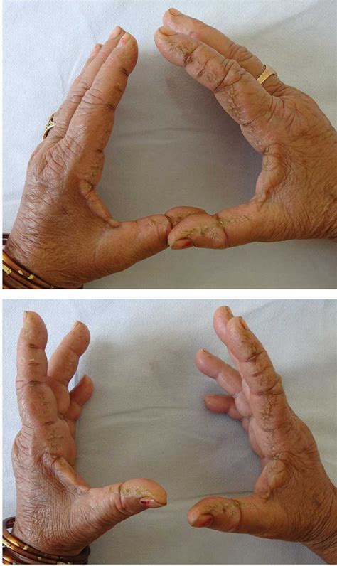 Hyperkeratotic Fissured Plaques On Both Hands Mechanics Hands Cleveland Clinic Journal Of