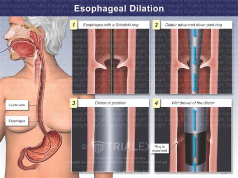 Esophageal Dilation Trial Exhibits Inc