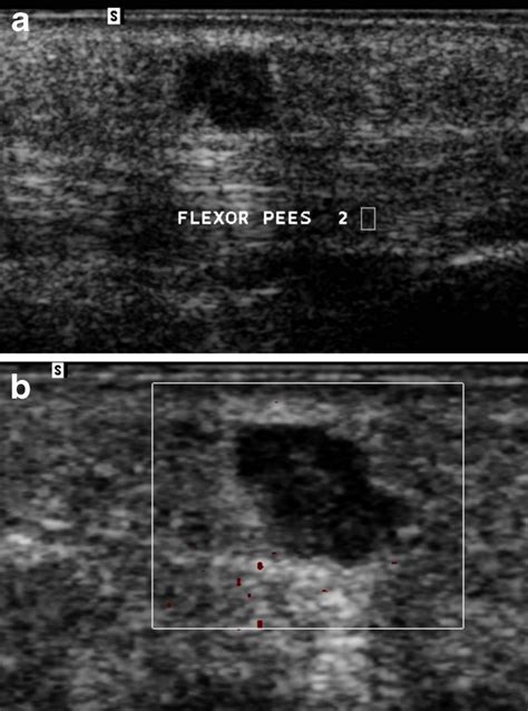 Ultrasound Of Epidermoid Cyst On The Sole Of The Foot The Ultrasound