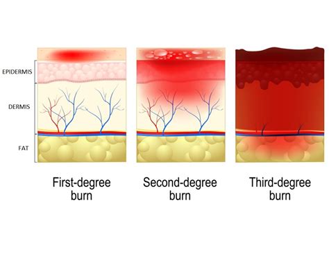 Fourth Degree Burn Diagram