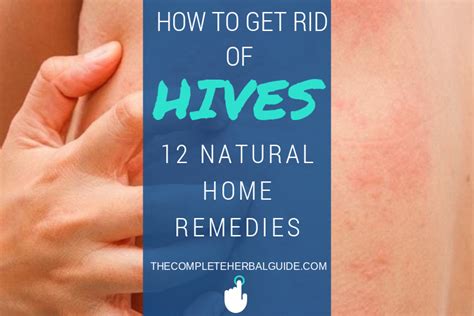 8 Ways To Get Rid Of Hives Health And Natural Healing Tips