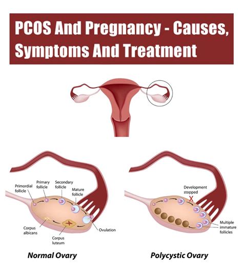 Pcos And Pregnancy Symptoms Treatment And Tips To Conceive