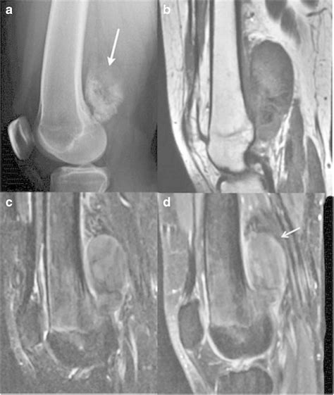 6parosteal Osteosarcoma On The Left Distal Posterior Femur A Lateral