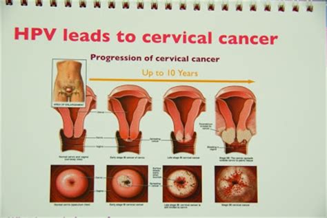 It is good to know what is these are screening tests (looking for signs of cervical cancer) and not diagnostic (confirming. Cervarix -The Medical Revolution: Cervical Cancer ...