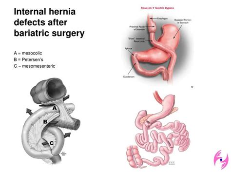 Ppt Internal Hernia A Brief Review Of Its Clinical Features And