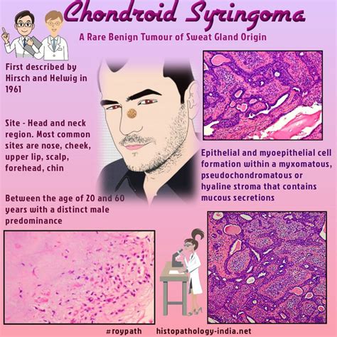 Pathology Of Chondroid Syringoma Pathology Sweat Gland Subcutaneous