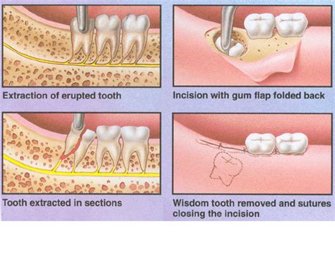 How Long Does Your Wisdom Teeth Take To Grow Teethwalls