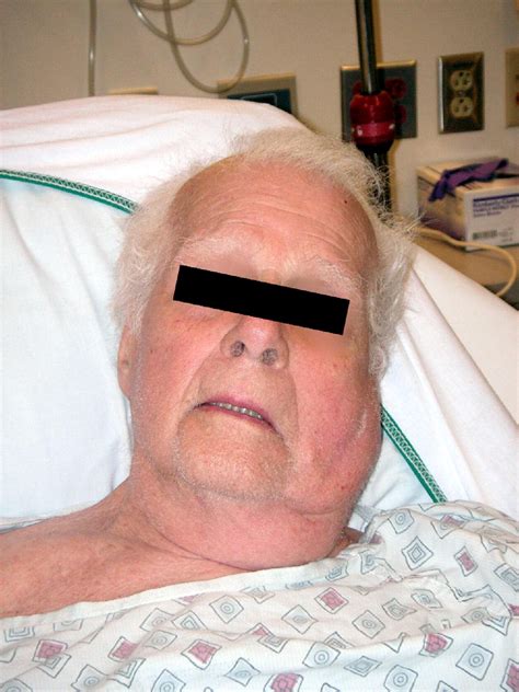 Elderly Male With Cheek Swelling Annals Of Emergency Medicine