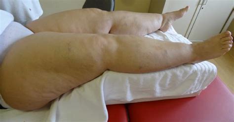 Wie lassen sich schmerzen lindern und die fettverteilungsstörung behandeln? Das Lipödem