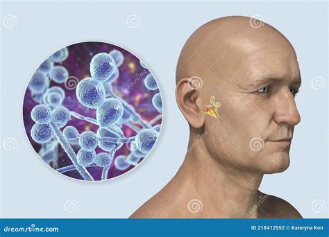 Candida Fungi As A Cause Of Otitis Media 3d Illustration Stock