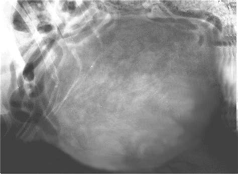 Uterine Liposarcoma In A German Shephard Dog