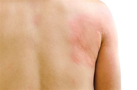 Chronic Hives Hedberg Allergy