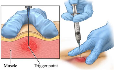 Trigger Point Injections Trigger Point Injection Technique And Side Effects
