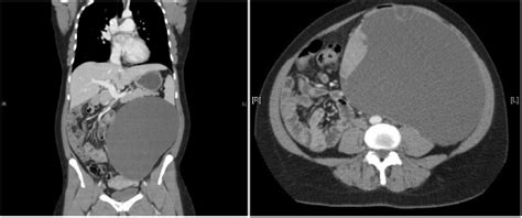 A Giant Mucinous Borderline Neoplasm Of The Mesentery Misdiagnosed As