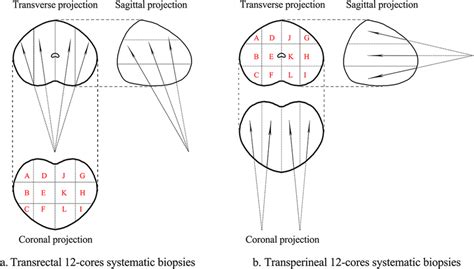 Transrectal And Transperineal Prostate Biopsy Model Diagram