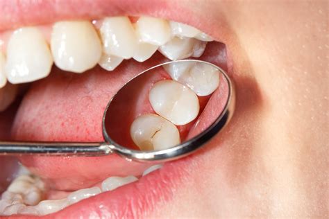 Dental Filling Procedure What To Expect Enamel Dental Centre