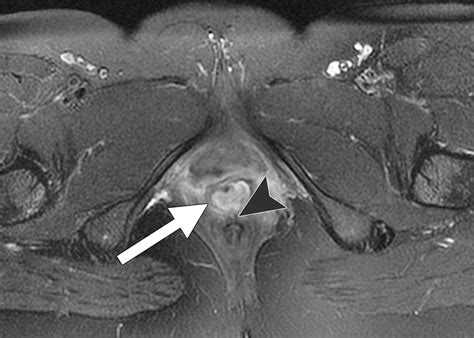 Imaging Of Acute Conditions Of The Perineum Radiographics