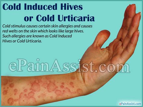 Cold Induced Hives Or Cold Urticariacausestypessymptomsrisk Factors