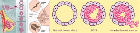 Pathology Report Pathologist Melbourne Vic Breast Cancer Surgery