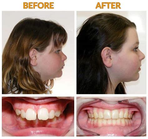 The Jawline Stretch A Safe And Effective Treatment For An Overbite Justinboey