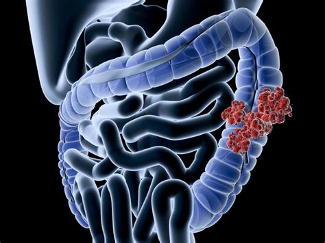 Colon Cancer Symptoms Treatment And Causes