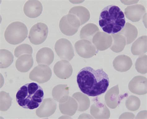 Typical Flower Cell In The Peripheral Blood Open I