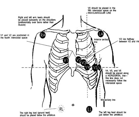 12 Lead Ecg Electrode Placement