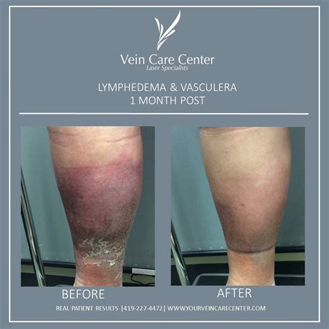 Lymphedema Therapy Before And After Lima Ohio Vein Care Center