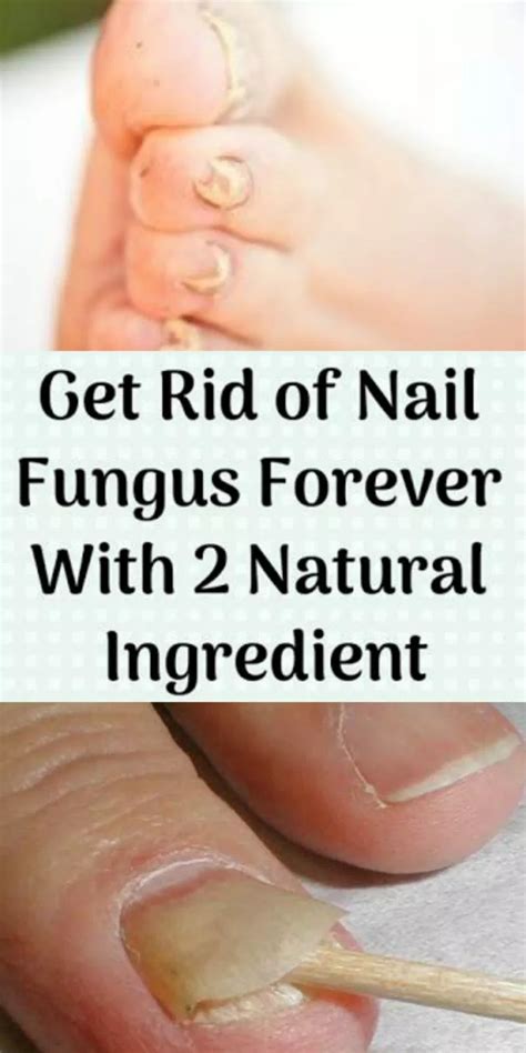 Get Rid Of Nail Fungus Forever With 2 Natural Ingredient Home Health
