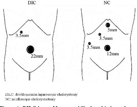 Table 1 From Comparison Of Double Incision Laparoscopic Cholecystectomy