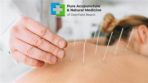 Acupuncture In Boca Raton Florida Pure Acupuncture