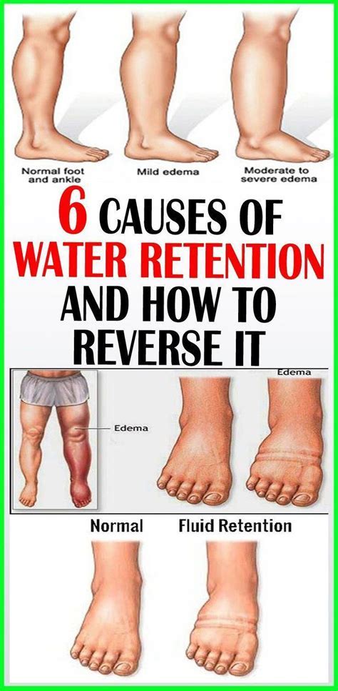 Understanding Fluid Retention Causes Symptoms And Heart Health Implications Reasons For Disease