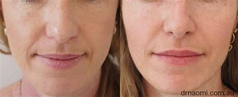 Before And After Dermal Filler To Lips And Cheeks Best Clinic Sydney