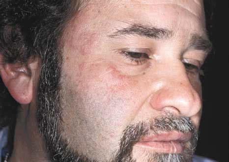 The eruption was associated with a burning sensation. Common Vesiculobullous Diseases Etiology,Clinical ...