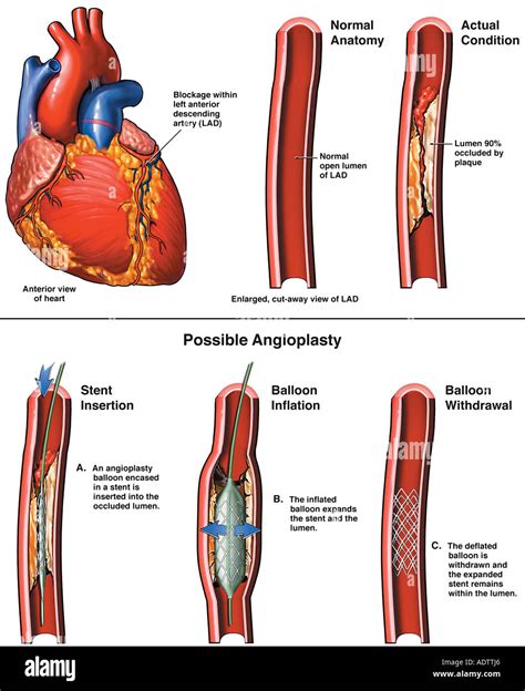 Estenosis Arterial Fotografías E Imágenes De Alta Resolución Alamy