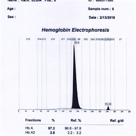 Cze Electropherogram Of Normal Human Hemoglobins Hba 943 Hbf