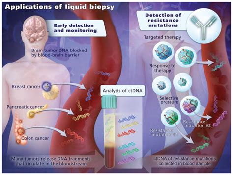 Liquid Biopsy Revolutionizing Cancer Diagnoses And Treatments