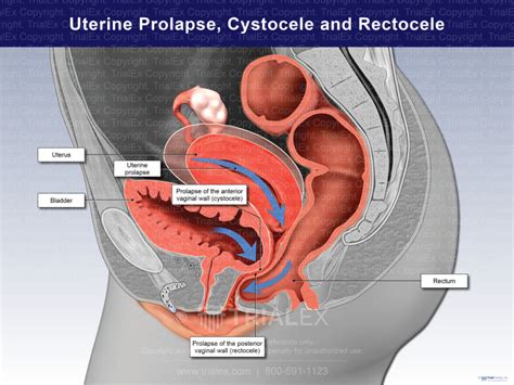 Uterine Prolapse Cystocele And Rectocele Trial Exhibits Inc