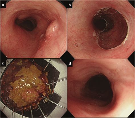 Endoscopic Resection For Superficial Esophageal Squamous Cell Carcinoma