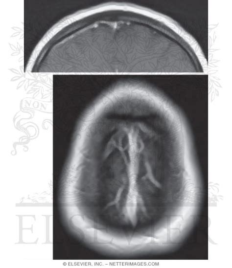 Relationship Of Superior Sagittal Sinus With Sagittal Vrogue Co
