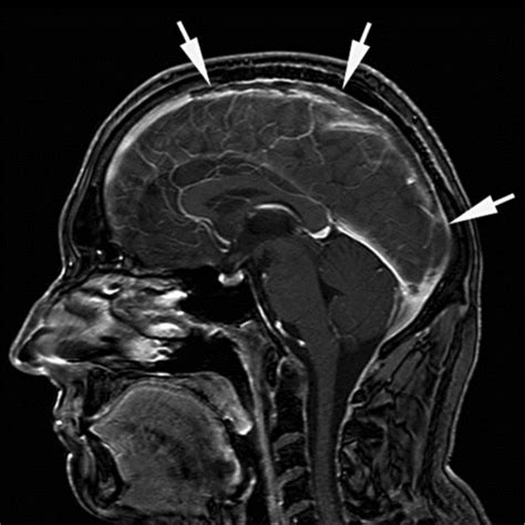 Cerebral Sinus Venous Thrombosis In The Superior Sagittal Sinus