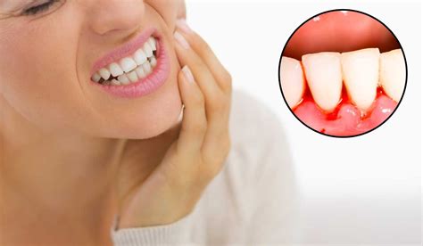 GUM DISEASE SYMPTOMS United Dentist