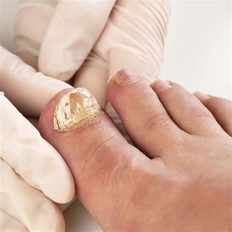 What Is White Toenail And How To Fix Them Marietta Foot Doctor