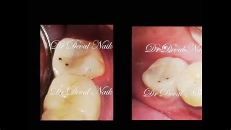 Pin Retained Composite Restoration By Dr Deval Naik Youtube