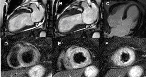 Cmr Findings In A Patient With Stress Induced Cardiomyopathy Takotsubo
