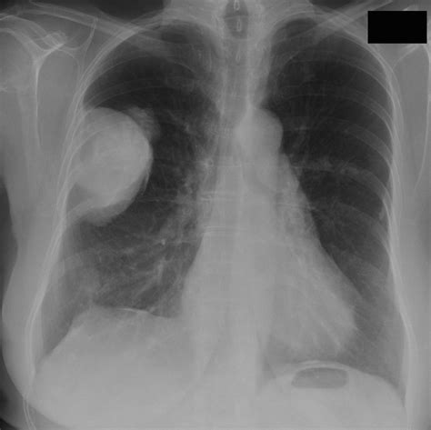 Pleural effusion is a lung condition characterized by fluid buildup outside the lungs. Radiology Quiz 20730 | Radiopaedia.org